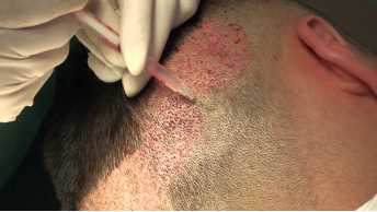 Before Hair Transplant Surgery